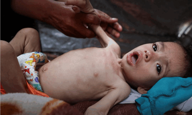 تحذيرات من تفاقم الأزمة الصحية في غزة بعد تسجيل إصابات بـ"التهاب السحايا"