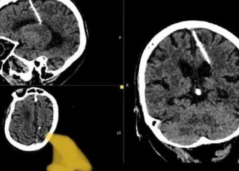 العثور على إبرة في دماغ امرأة منذ 80 عاما