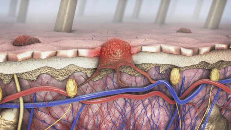 ما علاقة التقدم في العمر بانتشار سرطان الجلد؟