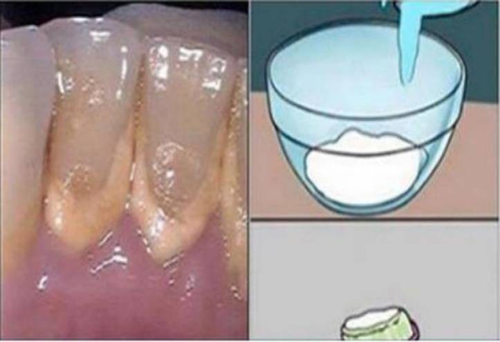 غسول الفم هذا يزيل الجير عن الأسنان في دقيقتين!