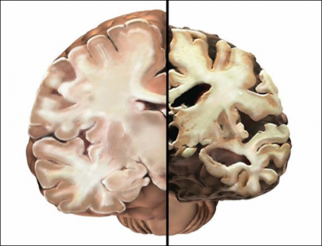 دراسة صادمة: الهواء يُسبب الزهايمر للرضع!