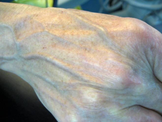 لماذا يظهر الدم بلون أزرق على الجلد رغم أنه في الحقيقة أحمر؟