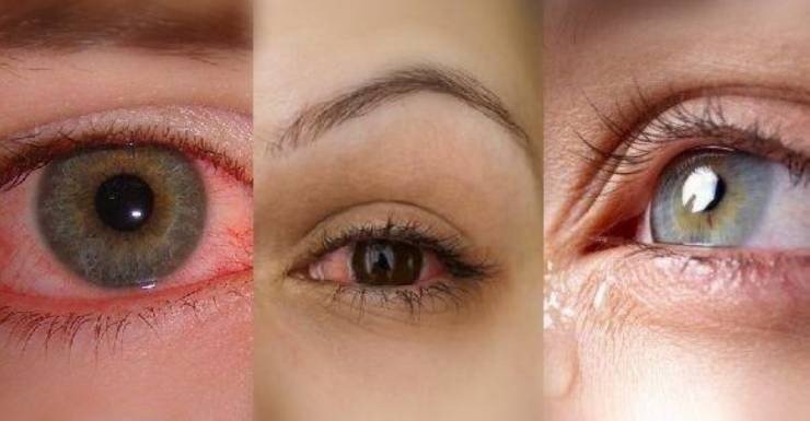 كيف نتخلص من مشكلة جفاف العين؟