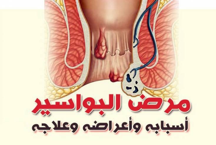 بالفيديو : أفضل طرق علاج البواسير في منزلك.. دون جراحة نهائياً!