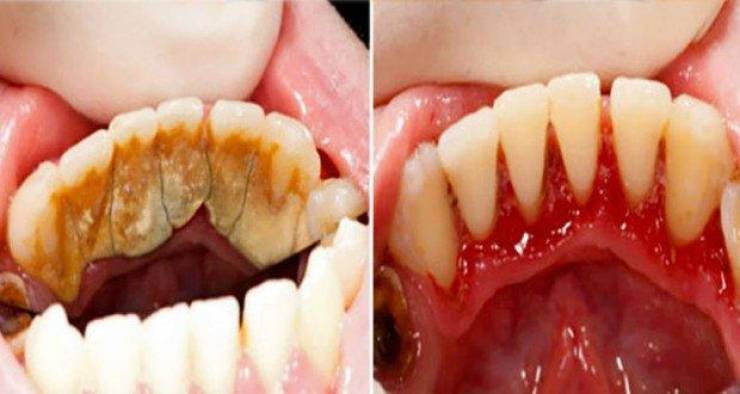 تخلص من رواسب الأسنان بمكونات بسيطة وخلال خمسة دقائق فقط!