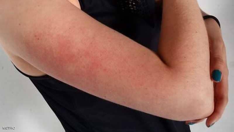 معضلة "جلد الدجاج".. أسبابها وكيفية علاجها