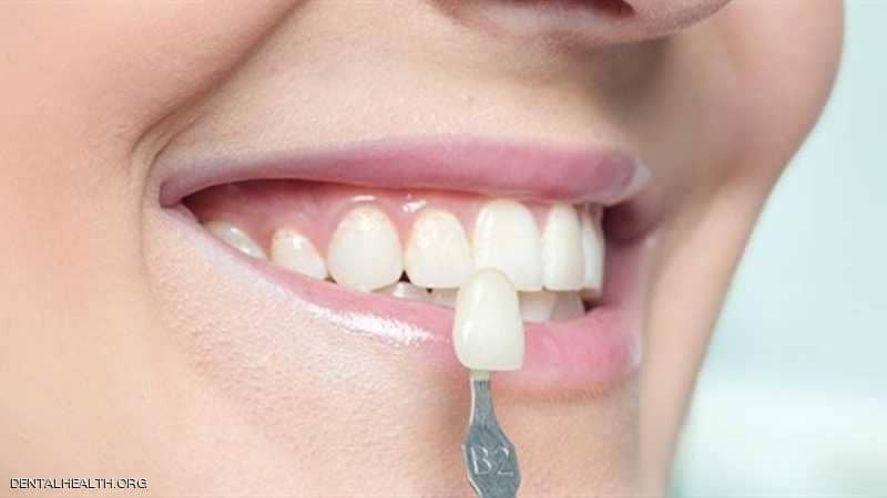 عدسات الأسنان اللاصقة.. حل تجميلي بتكلفة باهظة