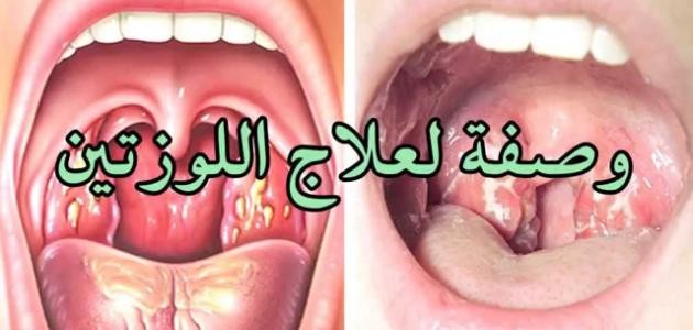 أسرع 4 مشروبات لعلاج التهابات اللوزتين!