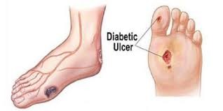حل جديد لعلاج جروح وتقرحات مرضى السكري