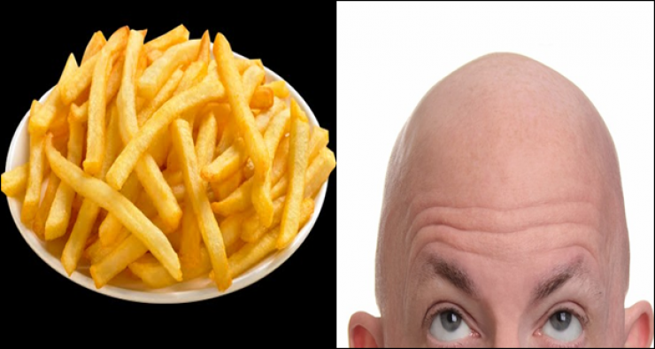 ما علاقة البطاطا المقلية بالصلع؟