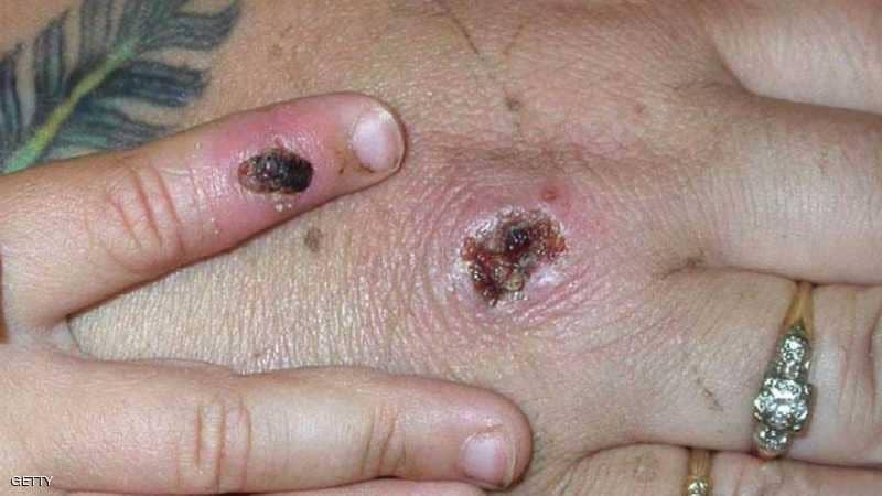 الإعلان عن ثالث إصابة بـ"جدري القرود" في بريطانيا