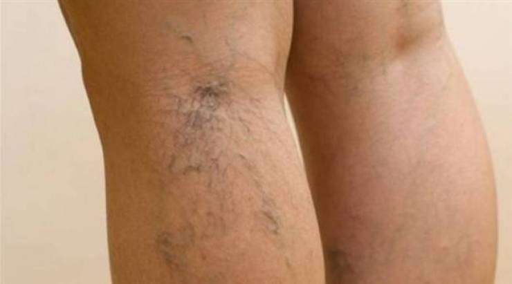 الأوردة العنكبوتية تنذر بمشاكل صحية خطيرة